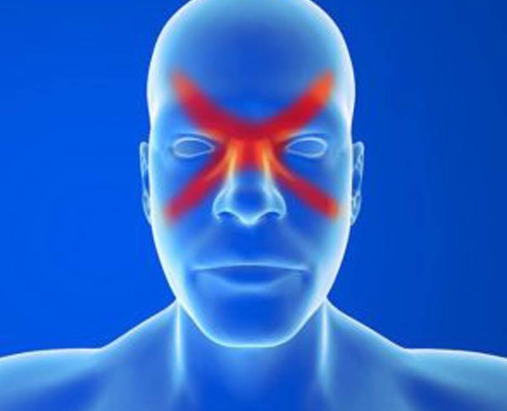 identify sinus migraine