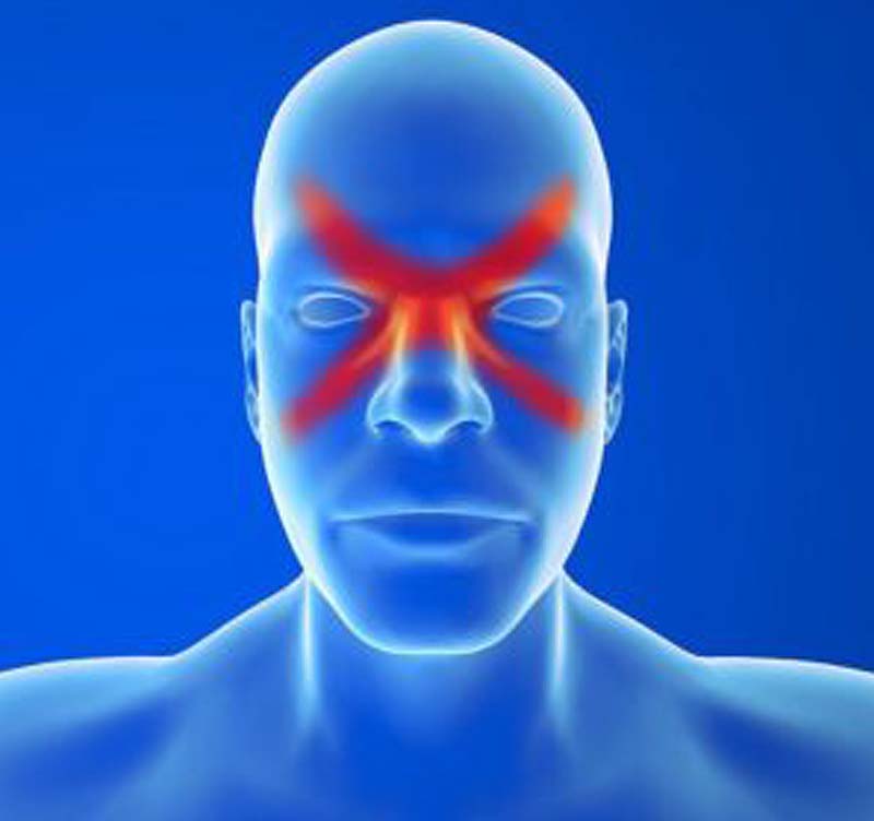 identify sinus migraine